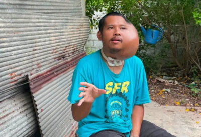 左臉長出「巨大腫瘤」跟頭一樣大！　泰男疑牙籤挖蛀牙害嚴重發炎