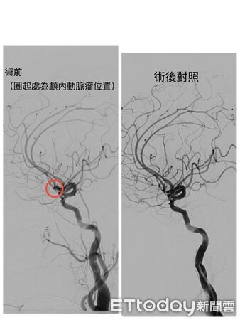 ▲林女術前及術後影像對照圖。（圖／衛福部南投醫院提供）