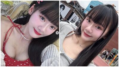 蟹足腫體質昆娜赴韓割雙眼皮 台醫揭「10家不敢保證」原因曝
