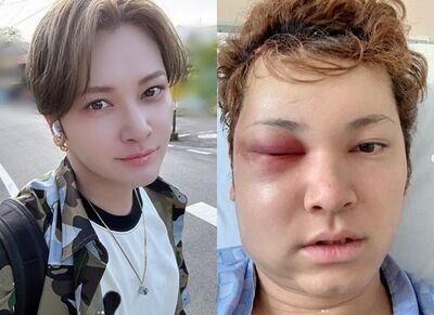 日男星罹罕病開腦毀容!消失7年「成身心障礙人士」 患癲癇後遺症