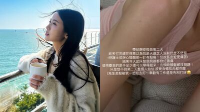 大元打帶狀皰疹疫苗 「隔天2症狀」傻眼:以為我是天選之人