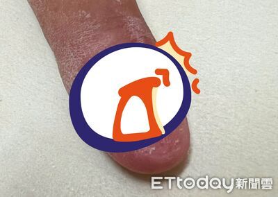 赴陸治灰指甲「被刮到見肉」痛爆！醫一看搖頭：像熟透的番茄
