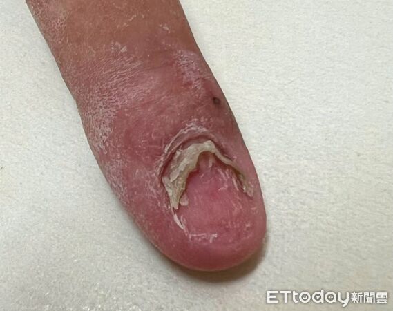 赴陸治灰指甲「被刮到見肉」痛爆！醫一看搖頭：像顆熟透的番茄。（圖／吳仁欽醫師授權提供，未經同意請勿任意翻攝）