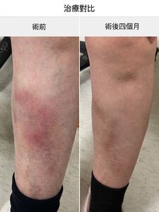 婦抱孫一夜雙腿紅腫痛到走不了 醫示警靜脈曲張恐血栓前兆