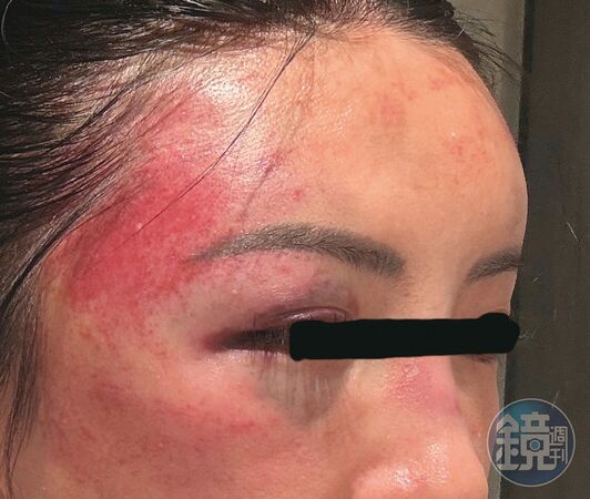 受害人遭許可宗用拳頭猛揍臉部，幾乎要面目全非。（A女提供）