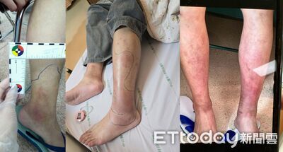 「醫師,鍋貼請你吃到飽」 25歲罕病男幹細胞移植成功重拾人生