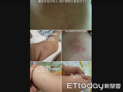 4歲童入學3週全身傷！疑遭教保員狠拖...腋下大腿全黑青　家長心碎