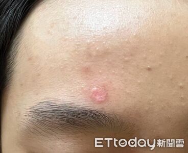男孩額頭長一顆！醫一打燈驚見「迷你肚臍」：根本不是痣