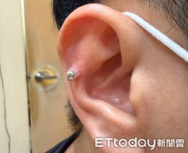 耳朵凸「一根肉柱」像菜花！他忍5年越長越大　醫：千萬別用噴的