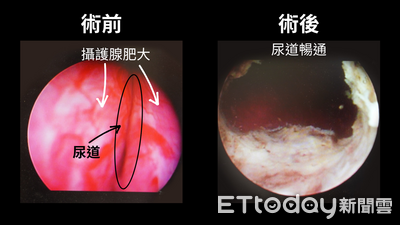 攝護腺肥大到重如「2顆蛋」 忍多年連膀胱都受損