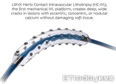 血管鈣化硬得像石頭 新型「狼牙棒」導管可震裂斑塊助放支架