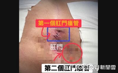 年薪300萬型男業務超慘!開車「屁股突爆漿」 褲子一脫醫搖頭了
