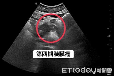 胰臟癌「早期唯一症狀」醫示警!他胃痛瘦5kg…一照已第4期