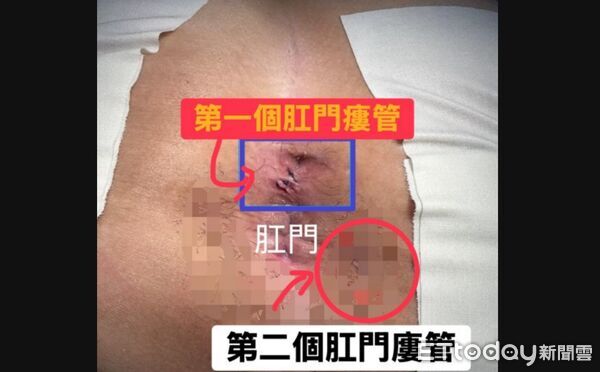 年薪300萬型男業務超慘！開車「屁股突爆漿」 褲子一脫醫搖頭了