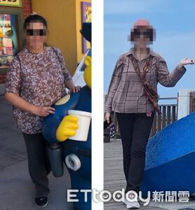 每胖1公斤膝蓋多扛4公斤 婦手術成功瘦身也保住膝關節