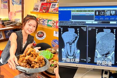 大胃王小慧公開胃部CT照 「吃飽膨脹塞滿腹腔」女星驚呆:魯夫胃