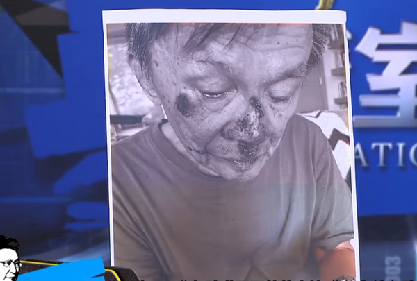 87歲沈富雄重摔滿臉血！受傷照曝光　親曝「腎臟移植過才會這樣跌」