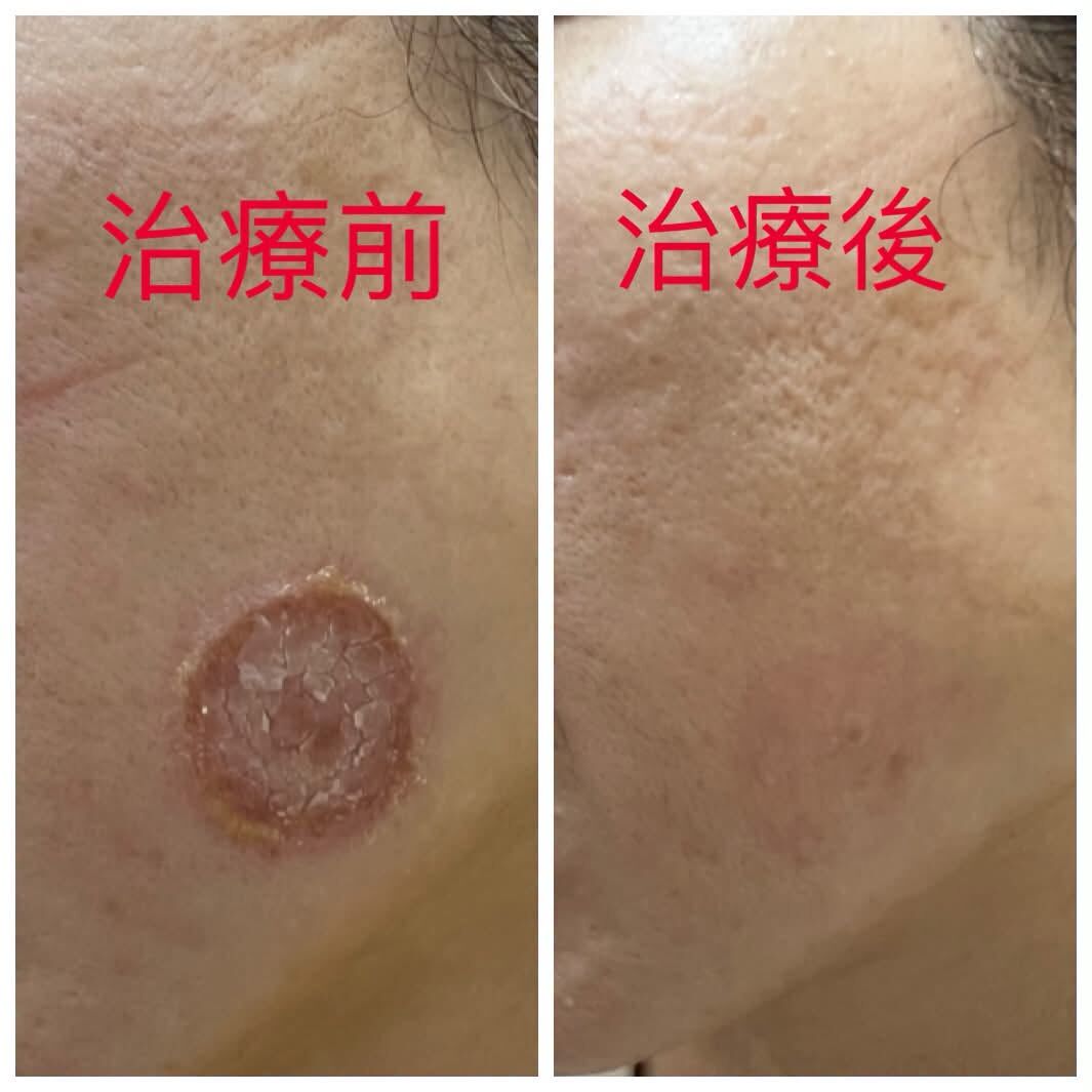 ▲▼妹子臉癢1週變「50元結痂大餅」!擦藥沒用 醫警告:傳染力超強。(圖/吳仁欽醫師授權提供,未經同意請勿任意翻攝)