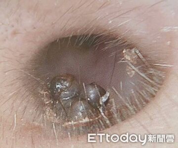 想清耳屎…他驚見「整坨黑凸起」嚇壞!醫一照急勸:別硬摳