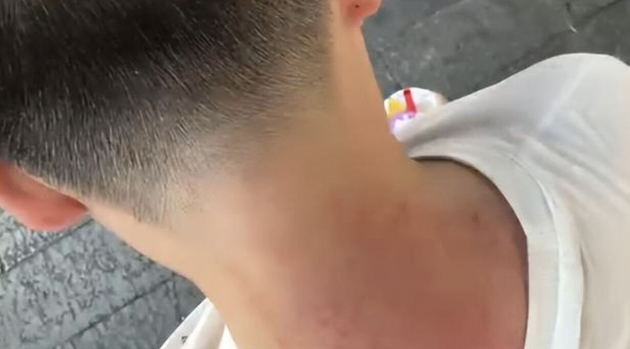 ▲陸男子在夜市體驗按摩,被5名大媽伺候到「皮膚紅腫」。(圖/翻攝大風新聞)