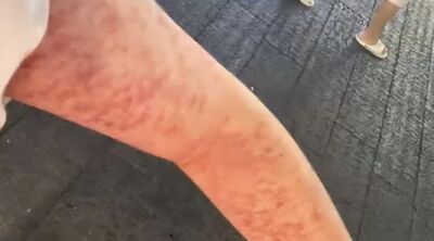 男子逛夜市被按摩大媽「5人10手」伺候 皮膚紅腫還被唸「痛就對了」