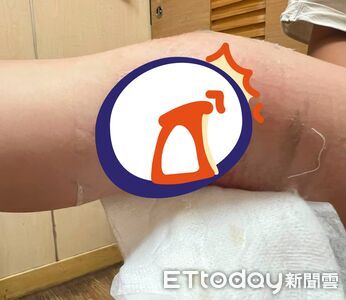 以為車禍！6歲弟「手腳包滿紗布」　醫一掀秒心疼：爸媽辛苦了