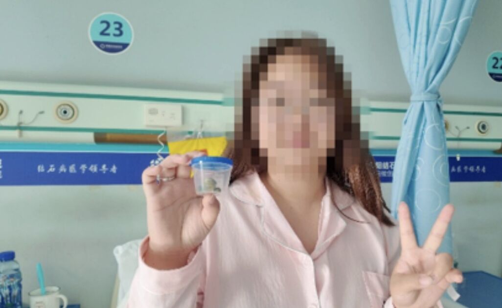 ▲28歲許姓女子體內取出貌似寶石「綠松石」的膽結石。（圖／翻攝新浪新聞）