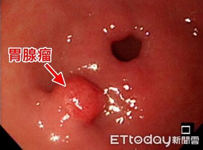 胃不痛拒檢查!男染「90%胃癌元兇」 醫一照驚見癌前病變