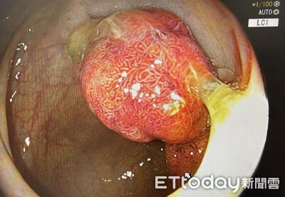 「近期年輕人最大息肉！」30歲男以為痔瘡　醫一照大腸鏡驚呆