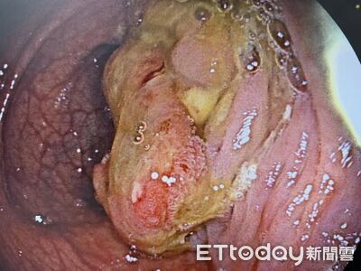 排便都正常！他「首次照大腸鏡」竟揪出癌　醫嘆：肝長滿腫瘤