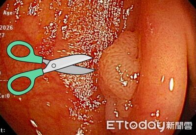一次切「15顆大腸腺瘤」！醫驚喊：真的少見　勸做3件事