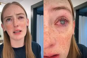 美19歲少女「戴隱形眼鏡洗澡」右眼全盲！　角膜遭阿米巴原蟲入侵