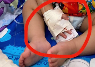 護士拆點滴「剪斷1歲男嬰手指」！泰國嚴重醫療疏失　2次手術才接回