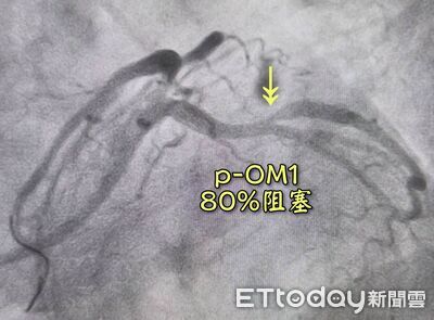 陪診人妻隨口「跟老公同症狀」!醫一查驚:2條大血管塞80%