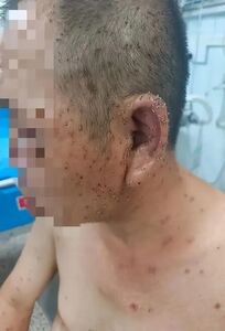 蜂蜇留下「千根毒刺」! 醫生花3小時才拔完
