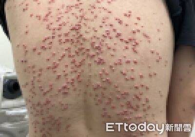 23歲男糖尿病失控!「黃紅色顆粒」炸滿背 醫抽血驚:飆破6千