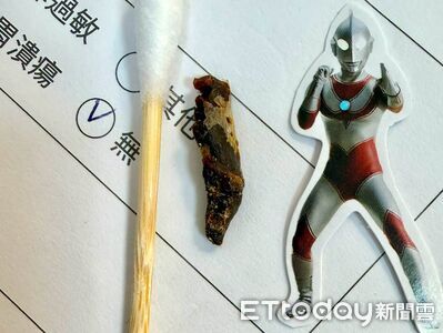 6歲弟喊癢!醫挖出養6年「巨型黑褐耳屎」 夾鏈袋裝回家