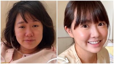 54萬YTR剖腹產3天「對比照變化超大」!關掉濾鏡:很奇妙不太習慣