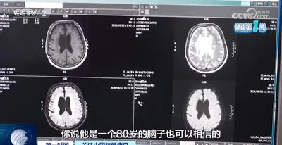 49歲男熬夜滑手機 突中風「大腦萎縮如80歲」