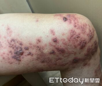 腿痠貼藥布2天！他「紫紅水泡狂冒」痛翻　醫：專挑神經下手