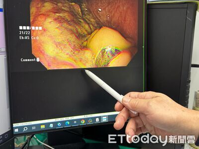 台中翁嘴破「忍痛1月」癌細胞吃掉骨頭 醫見7cm巨瘤:末期了