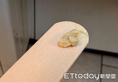 喉嚨痛飄腐爛味！她怕是癌　醫挖出「一坨臭到爆」：50%人都有