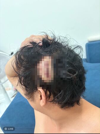 ▲▼被害的高男頭部遭酒瓶砸傷縫了好幾針             。（圖／翻攝FB）