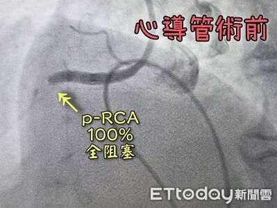 糖尿病不吃藥!她半夜痛醒「動脈100%塞死」 醫吸出暗紅血栓