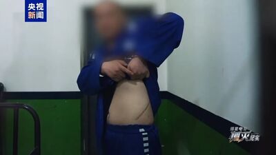 「豬仔」秀割腎刀疤 悲喊:只要能逃離「鋸腿、鋸手都願意」