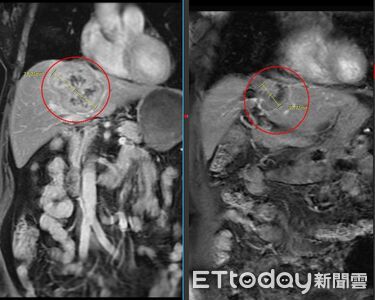 乳癌轉移到肝難開刀　醫用「雞尾酒療法」讓腫瘤縮小一半以上