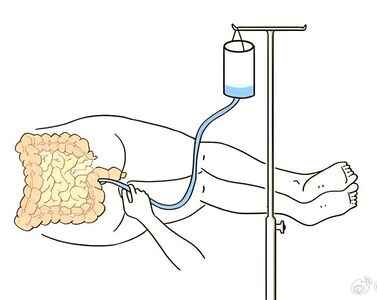 插歪了!42歲女做灌腸竟「把腸子被捅破」 大量糞便掉進腹腔