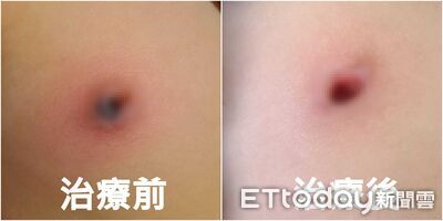 嚇!台中小一女童「乳頭被細菌吃光」 高燒不退急送醫