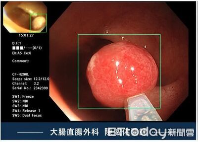 2年前大腸鏡正常!20多歲女便血「以為痔瘡」 醫驚見死角息肉
