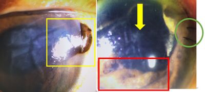 打羽球遭殺球暴擊!眼球破裂「虹膜掉眼外」 奇蹟救回視力